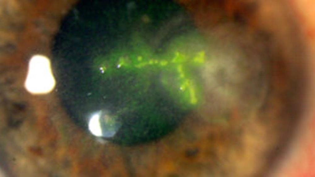 Keratoplasty following herpes simplex keratitis refractive management